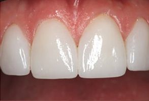 Paradise Before and After Teeth Whitening