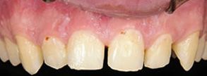 Las Vegas Before and After Dental Crowns