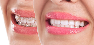 The image is a close-up photograph of a person s face with a focus on their teeth and lips, showcasing a smile.