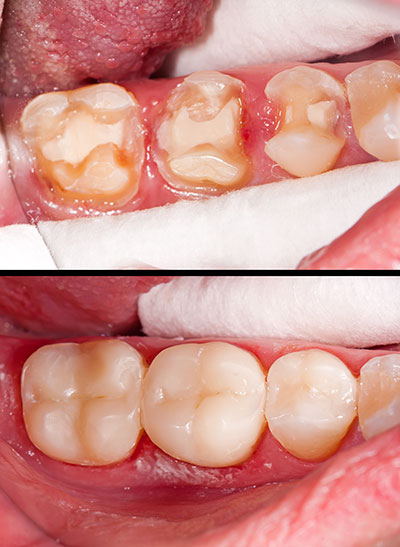 Dental implants with a close-up view of the surgical area and the finished result.
