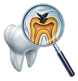 An illustration of a magnified human tooth, showcasing its internal structure and the presence of a cavity with a visible hole in the enamel.