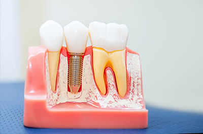 An image of a dental model with multiple teeth and a visible screw, showcasing the process of implantation or repair.