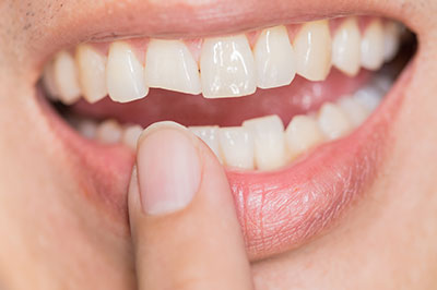 The image shows a close-up of a person s mouth with teeth, holding a finger near their teeth, and there is a focus on the dental work.