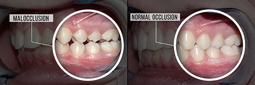 The image shows a close-up of a person s teeth, with two panels side by side. On the left panel, the teeth appear to be in good condition, while on the right panel, there is visible damage and decay to the teeth.
