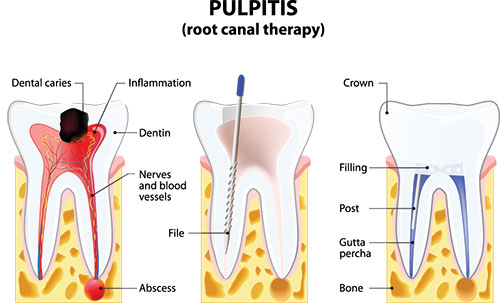 The image is a medical illustration showing the internal structure of a tooth, including the pulpitis with inflammation and infection, labeled with annotations such as  dental caries,   inflammation,   crown,   filling,   neurovascular bundles,   abscess,   file,  and  gutta percha.