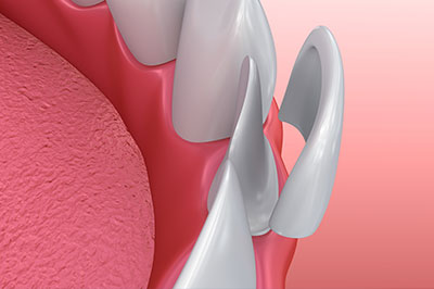 The image shows a close-up of a dental implant with a pink gum tissue background and is likely used for educational or promotional purposes.