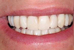 The image shows a close-up of a person s smiling mouth with white teeth, revealing part of their face.