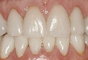A close-up of a person s teeth with visible staining and discoloration.