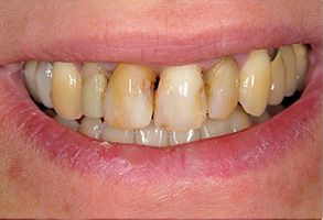 The image shows a close-up view of a person s teeth with noticeable discoloration, likely due to staining or decay.