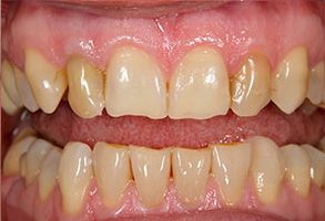 The image shows a close-up of a person s teeth with a focus on the lower front teeth, which appear to be yellowed and stained.