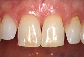 The image displays a close-up of a person s teeth with noticeable discoloration and staining, particularly on the lower front teeth.